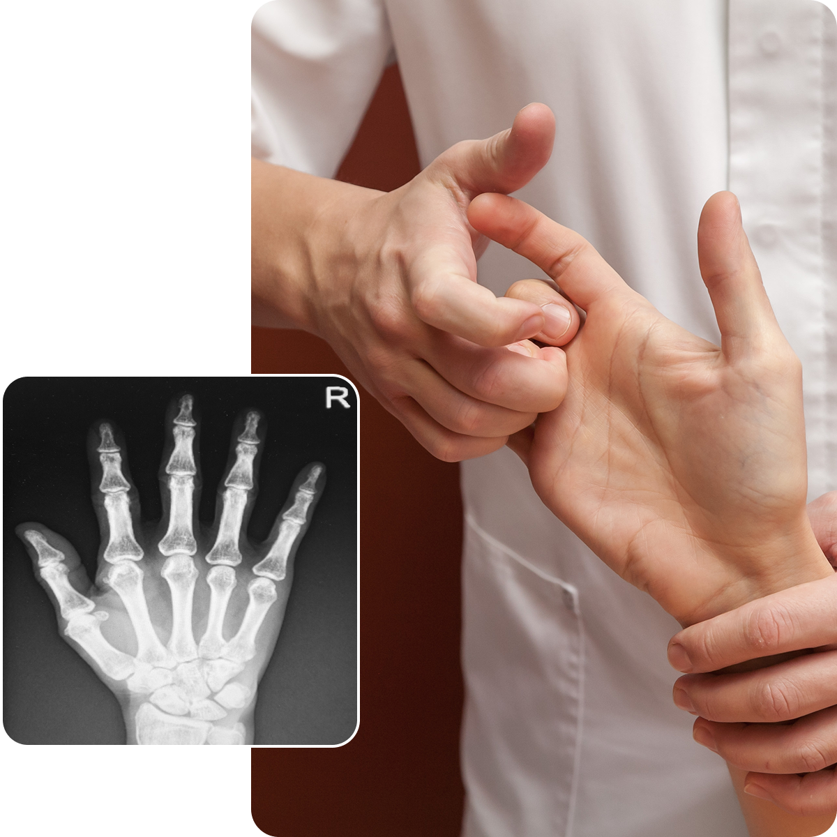 Hand therapy and X-ray comparison