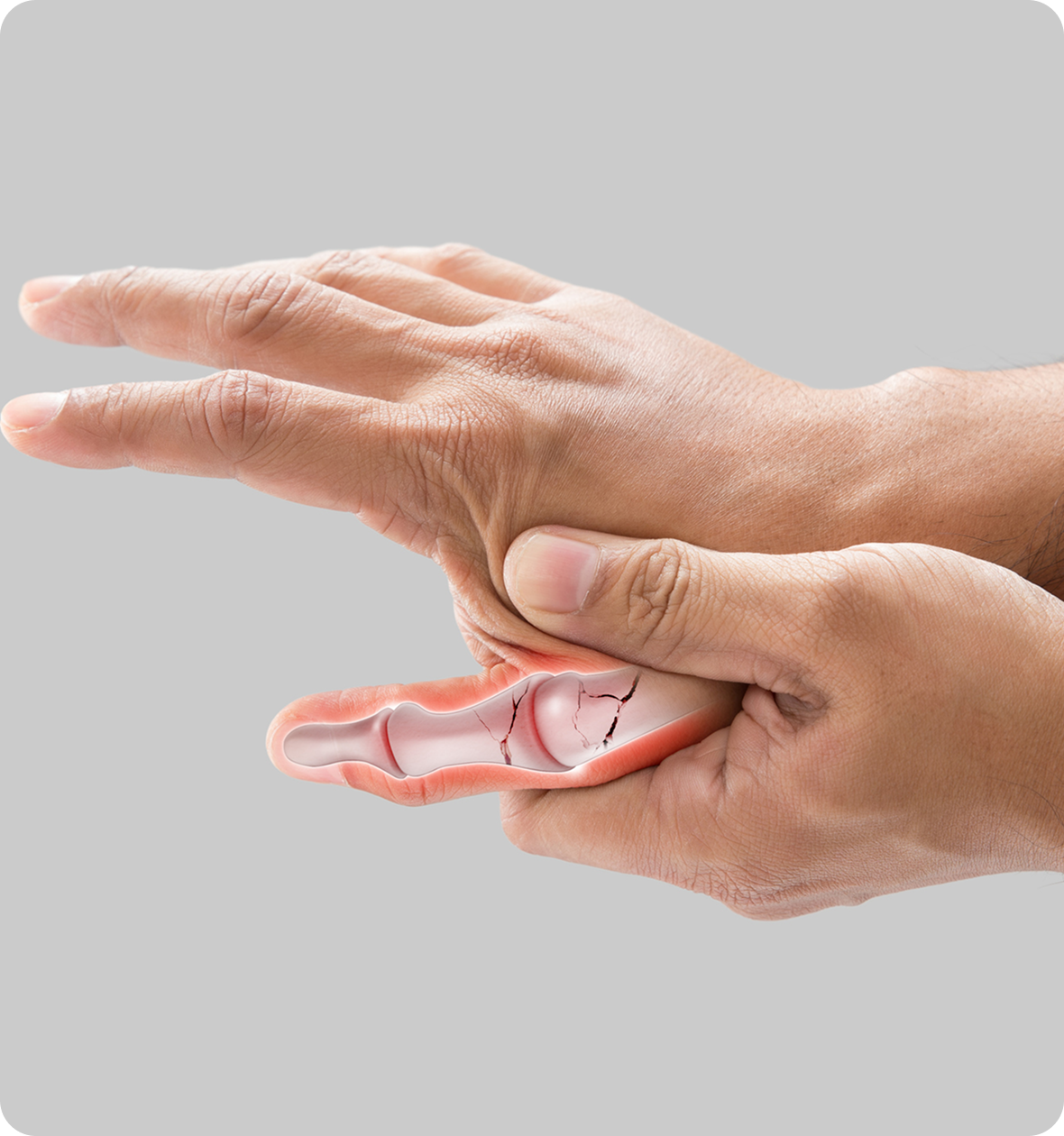 Hand holding a model of fractured finger