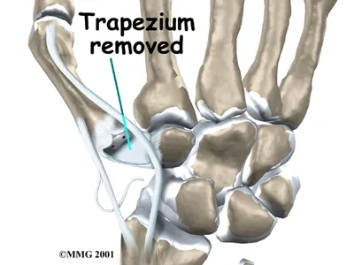Wrist bones illustration with trapezium removed