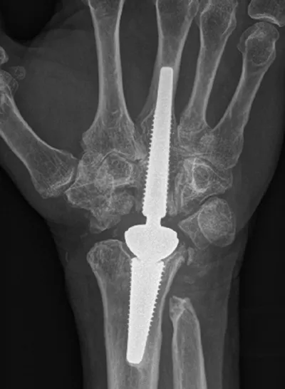 X-ray of a wrist with implant