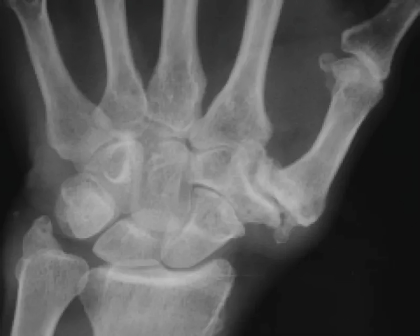 Broken wrist bones in X-ray